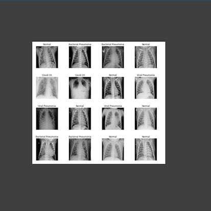AI-Powered Chest Disease Detection and Classification